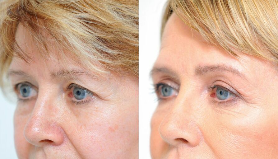 blefaroplastia-aurretik-ondoren